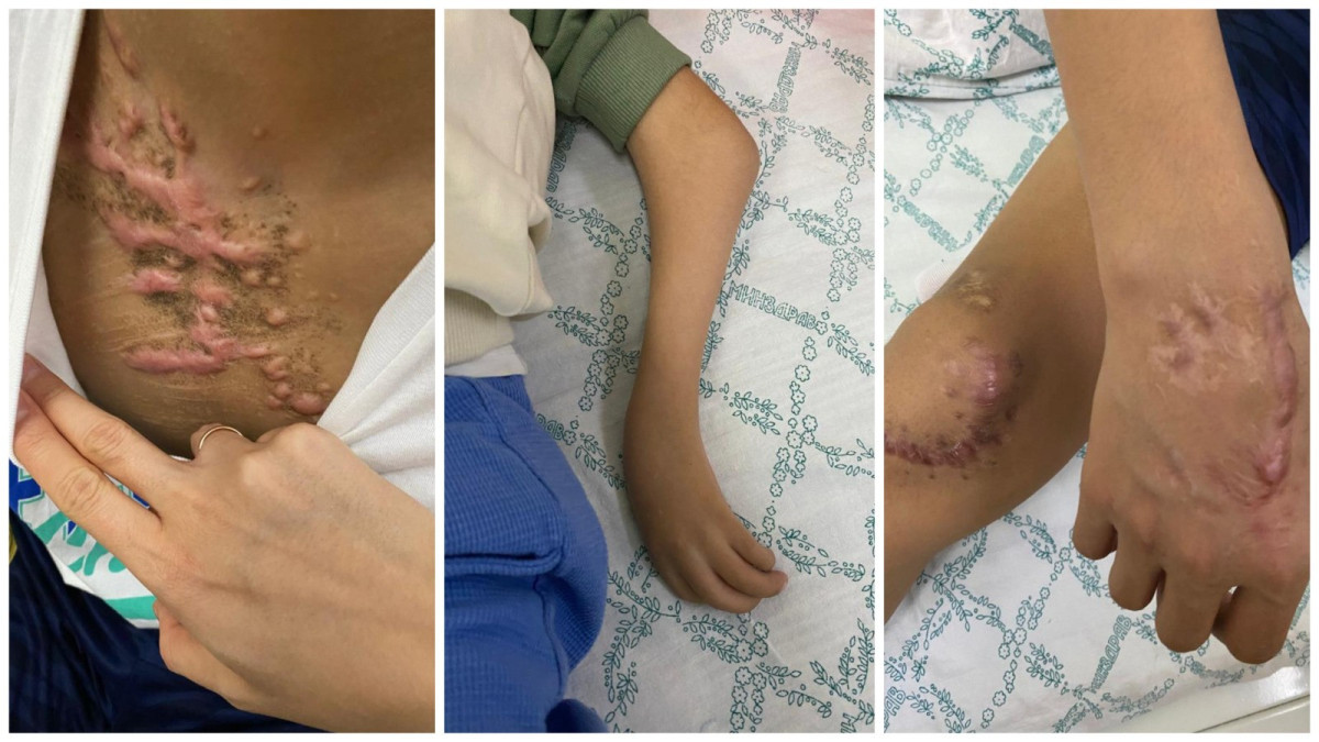 Уникальные совместные операции 8 казахстанским детям с редкими патологиями ног и рук провели врачи Алматы и Ярославля