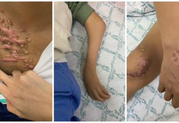 Уникальные совместные операции 8 казахстанским детям с редкими патологиями ног и рук провели врачи Алматы и Ярославля