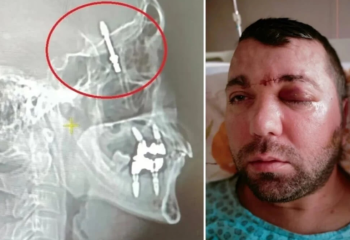 Тіс дәрігері науқастың имплантын миына кіргізіп жіберген