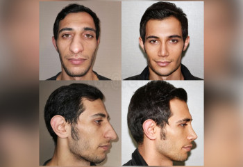 Фотографии «до» и «после» турецких пластических хирургов взорвали интернет