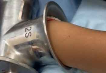 Алматы облысында 12 жастағы баланың қолын еттартқыш шайнап кетті