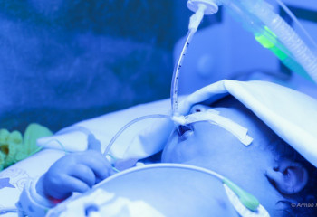 Қазақстанда жыл сайын 20 мыңға жуық нәресте шала туады