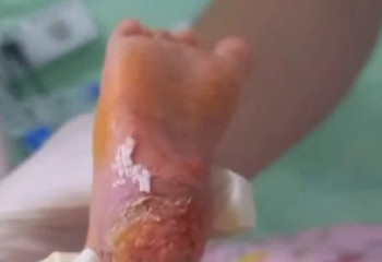 Қызылордада дәрігерлер сәбидің аяғын күйдіріп алған