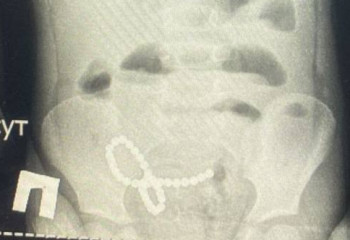 Ақмолада төрт жасар баланың ішегіне 39 магниттік шар тұрып қалған