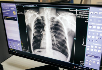 Атырауда туберкулезге шалдыққандар саны азайып келеді