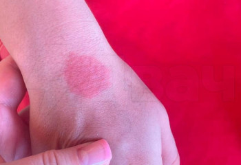 Салдары ауыр: Таиландтағы туристер арасында денге безгегі тарап жатыр