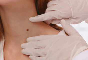 Онколог меланоманың қаупі жоғары адамдар тобын атады