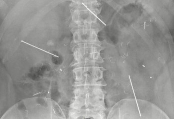 Американец месяц жил с 6-сантиметровыми гвоздями в животе