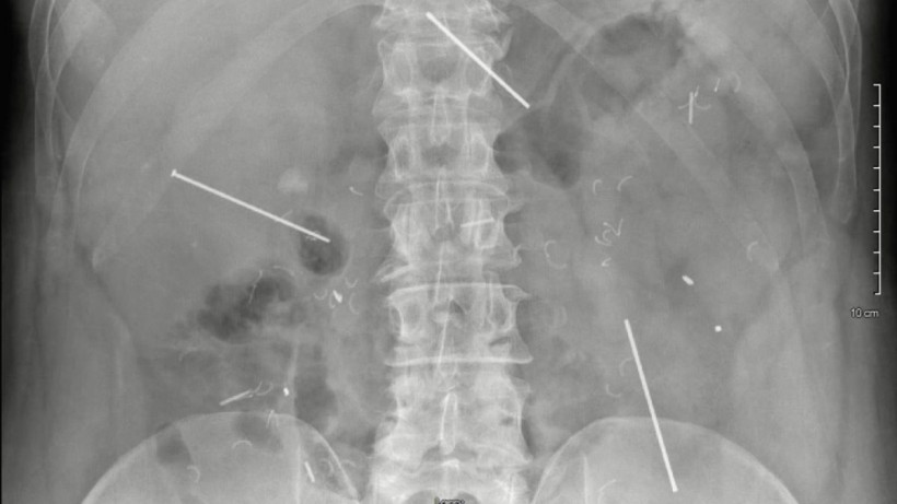  © Ahmed A E, Lopez Hanson R J, et al., Cureus 