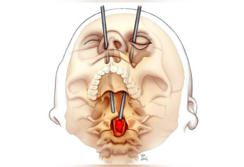 В США впервые удалили опухоль позвоночника через глаз: операция длилась 19 часов и не оставила шрамов