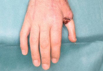 Дәрігерлер фермердің қолына аяғының басбармағын салып берді