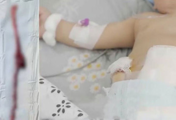 Фастфуд жеген баланың ішегі шіріп кеткен