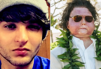 Әлемде алғаш рет беті мен екі қолы трансплантацияланған азамат туралы не белгілі?