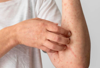 Елімізде қызылша жұқтырғандар саны азайды