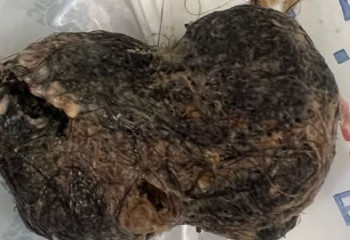 Жамбылда 18 жасар бойжеткеннің асқазанынан бір уыс шаш шықты