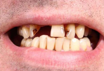 Түсіп қалған тістерді өсіретін препарат пайда болуы мүмкін