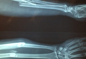 Микропластик сүйектердің түзілуін тежейді – ғалымдар