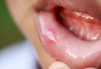 Балалар мен ересектердегі стоматитті қалай емдеу керек