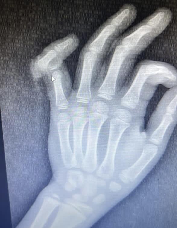 Спасти оторванный палец мальчика удалось врачам в Алматы