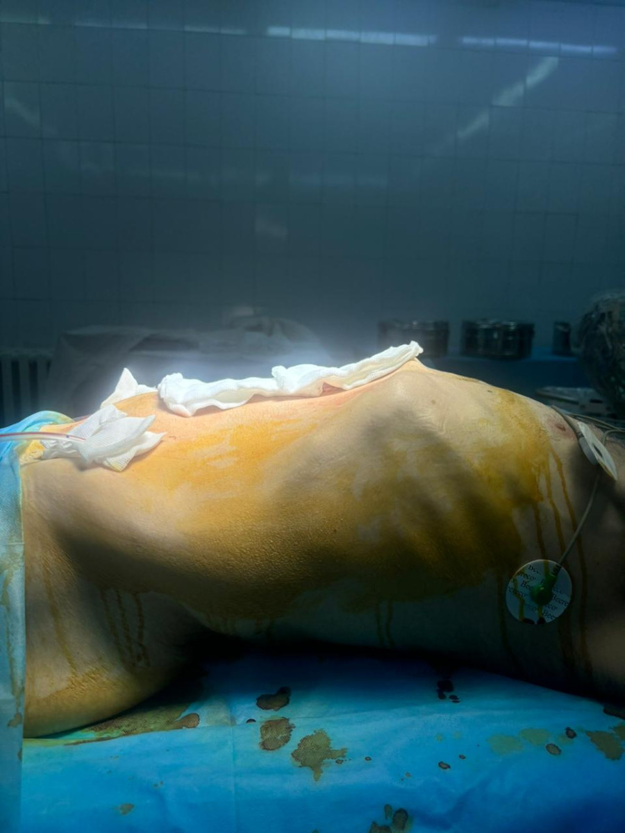 Мужчину с огромным «беременным» животом прооперировали ведущие хирурги Алматы