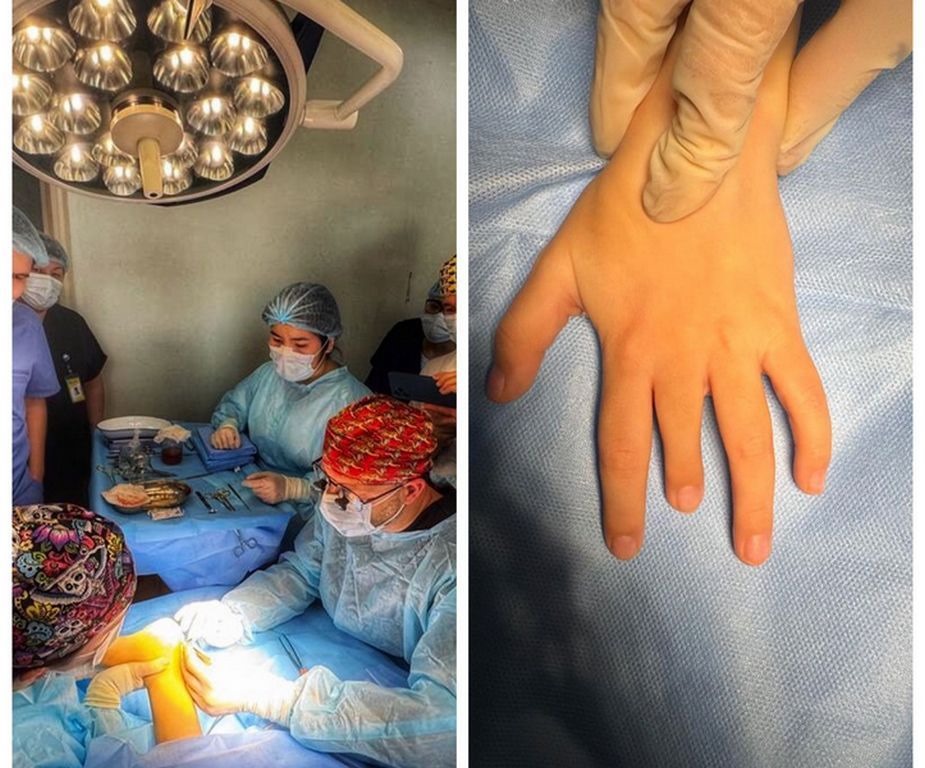 Девочка из Алматы с шестью пальцами на руке была прооперирована врачами