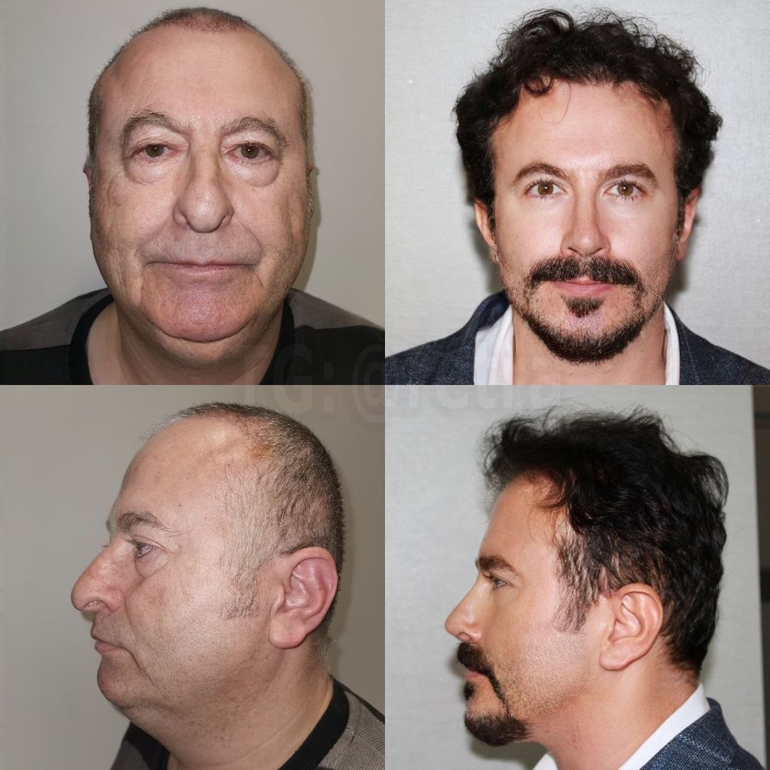 Фотографии «до» и «после» турецких пластических хирургов взорвали интернет