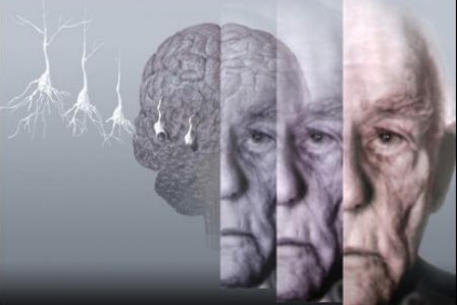 Альцгеймер ауруы жұқпалы болуы мүмкін